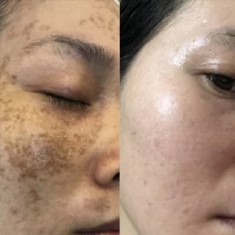 Red Carpet Facial — common symptoms