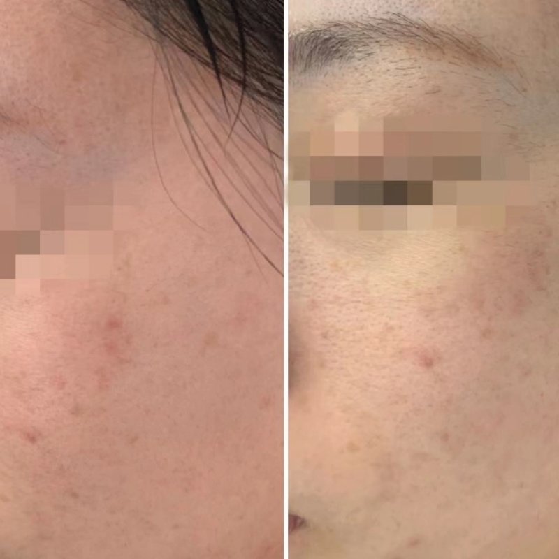 Texture & Pore Refinement — common symptoms