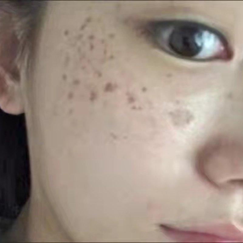 Uneven Skin Tone — common symptoms